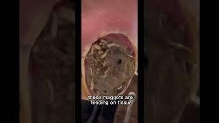 FOOT INVADED WITH MAGGOTS