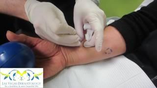 Sebaceous Cyst Removal at Las Vegas Dermatology