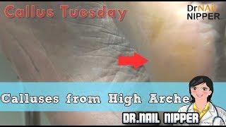 Do you have High Arches?  Calluses  #22 - Callus Tuesday