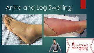 Top 10 causes of Ankle and Leg Swelling