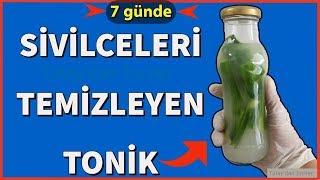 7 Günde SİVİLCEDEN KURTUL! SİVİLCE (Akne) NASIL GEÇER? SİVİLCE GİDERİCİ TONİK - GÜZELLİK &BAKIM