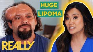 Dr. Lee Removes A HUGE Lipoma From A Patient's Head | Dr. Pimple Popper