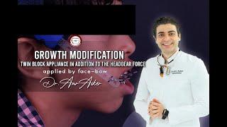 Growth Modification By Twin Block & Headgear