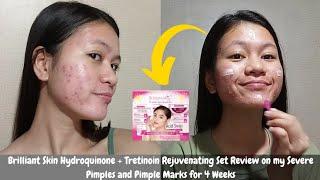 I tried Brilliant Skin Hydroquinone + Tretinoin Rejuvenating Set on my Severe Pimples & Pimple Marks