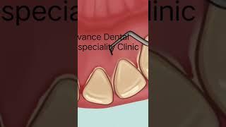 Teeth Cleaning / Scaling || Dr. Himanshu Mall || Advance Dental Multispeciality Clinic || Gwalior