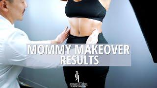 Mommy Makeover Surgery Reveal  Dr. Johnson C. Lee | Beverly Hills, CA