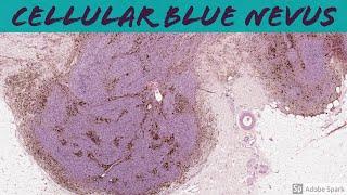 Cellular Blue Nevus: 5-Minute Pathology Pearls