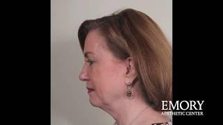 Can You Have a Neck Lift Without a Face Lift at Emory Aesthetic Center?