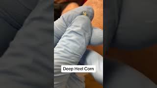 Very painful deep heel corn and callus removal by australian podiatrist in thenpodiatry clinic with