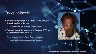 Anesthetic considerations: Meningomyelocele, Ecephalocele, Dandy-Walker Comlex, Chiari Malformations