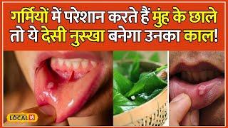 Mouth Ulcers Home Remedies: मुंह के छाले कर रहे हैं परेशान, तो करें ये 5 आसान घरेलू उपाय | #local18