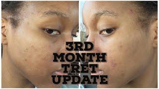 Tretinoin Update | Third Month Using Tretinoin .05% for Perioral Dermatitis and Acne | Review