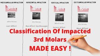 Classification of Impacted 3rd Molars | Oral Surgery