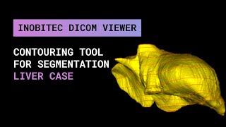 Contouring Tool for segmentation in Inobitec DICOM Viewer Pro. Liver case