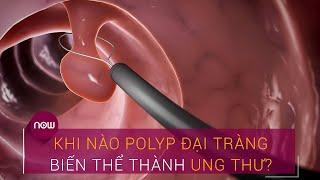 Khi nào polyp đại tràng biến thể thành ung thư? | VTC Now