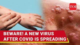 Covid Done, New Virus Emerges: 100s Killed, WHO Declares Global Health Emergency | Mpox Explained