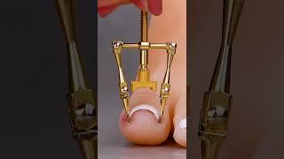 Ingrown toenail gadget hack #shorts