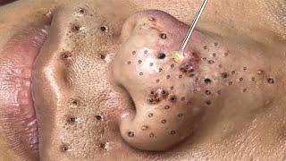 Blackhead Removal With Sac Dep Spa @100074126