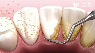 Профессиональная чистка зубов