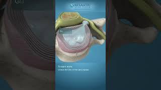 What is Endoscopic Anterior Cervical Discectomy? #shorts