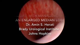 Urolift with management of an Enlarged Median Lobe - Dr. Amin S. Herati