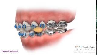 Foods To Avoid With Braces - Broken Bracket - Orthodontic Treatment