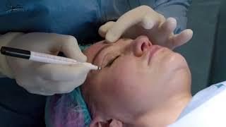 Upper Blepharoplasty and Brow Lift Procedure at Signature Clinic