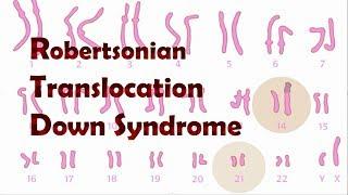 Robertsonian Translocation Down Syndrome (ROB)