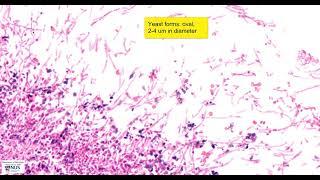 Oesophagus - Candidasis: Microscopy (Talking Slide)