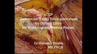eTEP (enhanced Totally Extra-peritoneal) by Optical Entry for Right Inguinal Hernia Repair