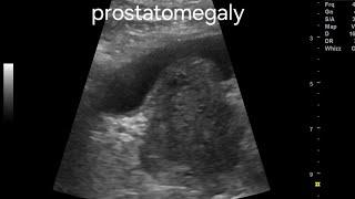 Grades or grading of prostatomegaly or benign hypertrophy prostate, on ultrasound