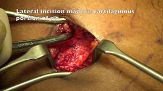 Rib harvest for dorsal augmentation in rhinoplasty - Dr Dennis Chua