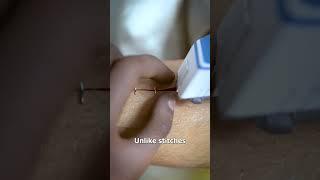 How Medical Staples Work 