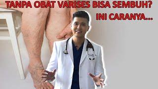 Cara Menghilangkan Varises Kaki Tanpa Obat