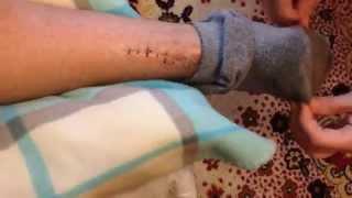 Разрыв Ахилового сухожилия от 08 04 2015 Часть 2. Akhil tendon rupture Part 2.