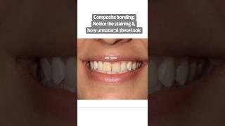 Composite vs porcelain veneers | Dr. Yazdan | porcelain veneers procedure | composite bonding stain