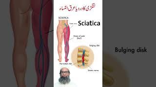 What is Sciatica Pain? - Langri Ka Dard - Arqun Nisa - Causes, Symptoms and Treatment | Urdu | Hindi