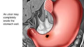 Что такое язва желудка? Основные причины язвы желудка.