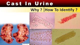 Cast in Urine  ( Why & How to Identify ? )