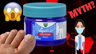 VICKS VAPORUB FOR TOENAIL FUNGUS: Myth or Magic?