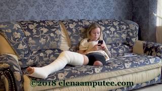 Elena amputee preview - Long Leg Cast