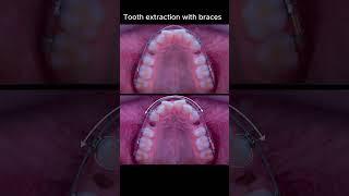 Don't worry about tooth extraction with braces #ardaarisan