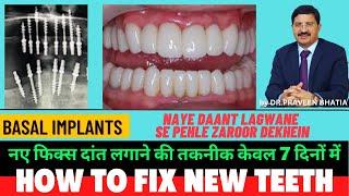 How To Fix New Teeth - LIVE- Fix Dant Kaise Lagate Hain II II Basal Implants