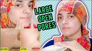 Treat Open Pores, Dark Spots & Skin Tanning at Home || 3 Easy Ingredients Only