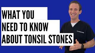 ASK DR. H - What You Need to Know About Tonsil Stones