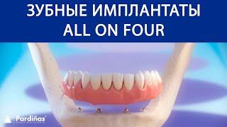 Зубные имплантаты «All on 4» ©