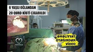 Medicina.az: Azərbaycanda 6 yaşlı oğlandan 20 qurd kisti çıxarıldı