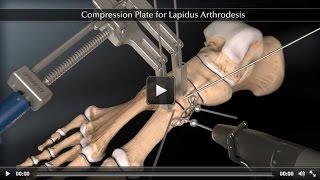 Compression Plate for Lapidus Arthrodesis