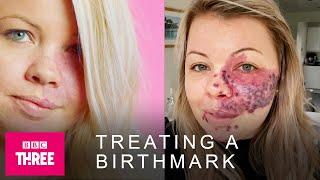 How A Facial Birthmark Is Treated: Skin