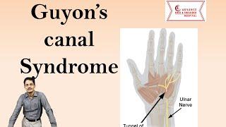 Guyon's Canal Syndrome